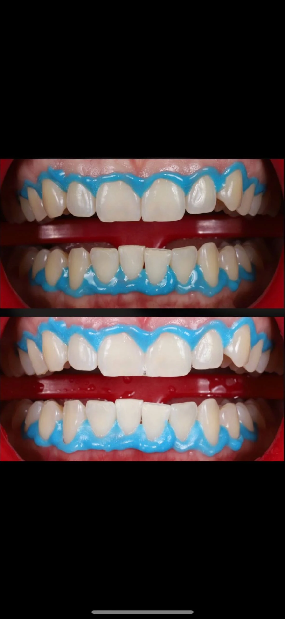 Результат гігієни зубів